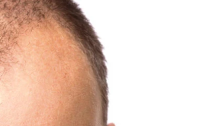 Freiner la chute des cheveux